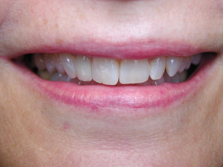 front tooth crown, front tooth veneer, Venincasa Dental