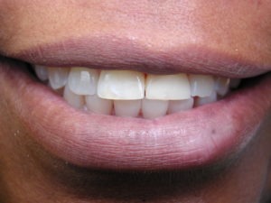 teeth gaps, Venincasa Dental