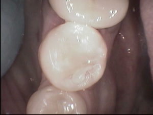 tooth colored fillings, Venincasa Dental, Dallas dentist