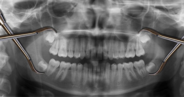 wisdom tooth extractions, Venincasa Dental, Dallas dentist