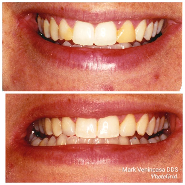 cosmetic dentistry, veneers, Venincasa dental