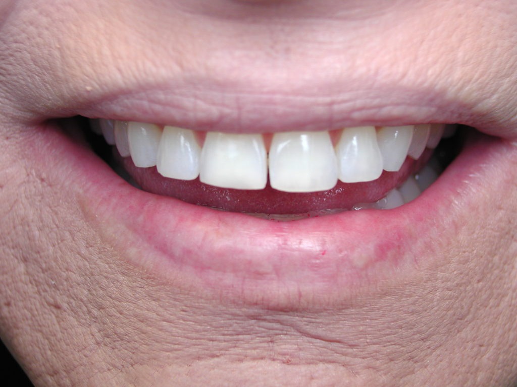 Repair Chipped Teeth With Bonding