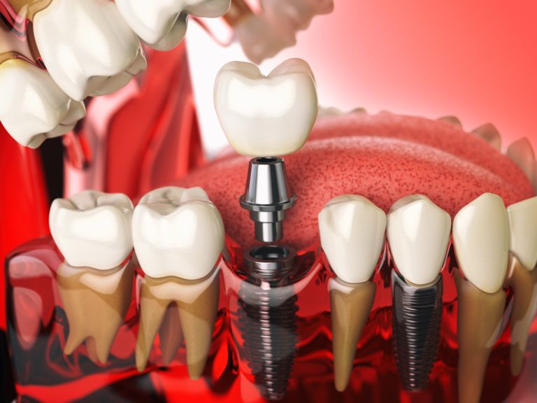 Tooth implant in the model human teeth, gums and denturas. Denta