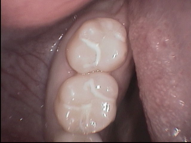 white fillings, composite fillings, bonding