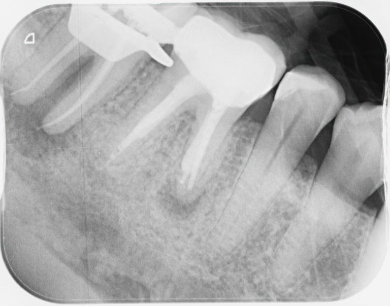 root canal, crown